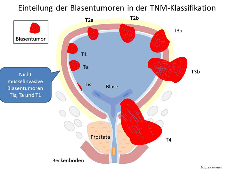 Tumorerkrankungen Asklepios Stadtklinik Bad Tölz